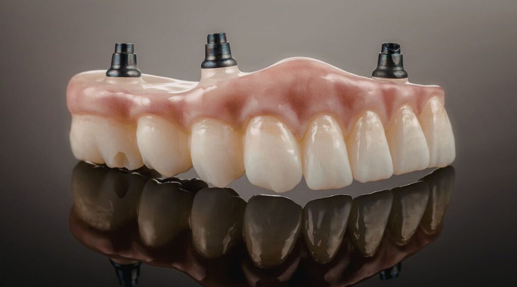 Dental Bridges